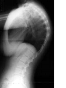 Kyphosis X-ray