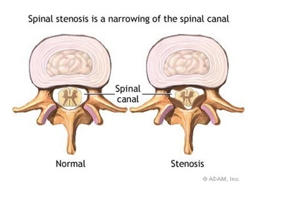 Spinal Stenosis Diagram.
