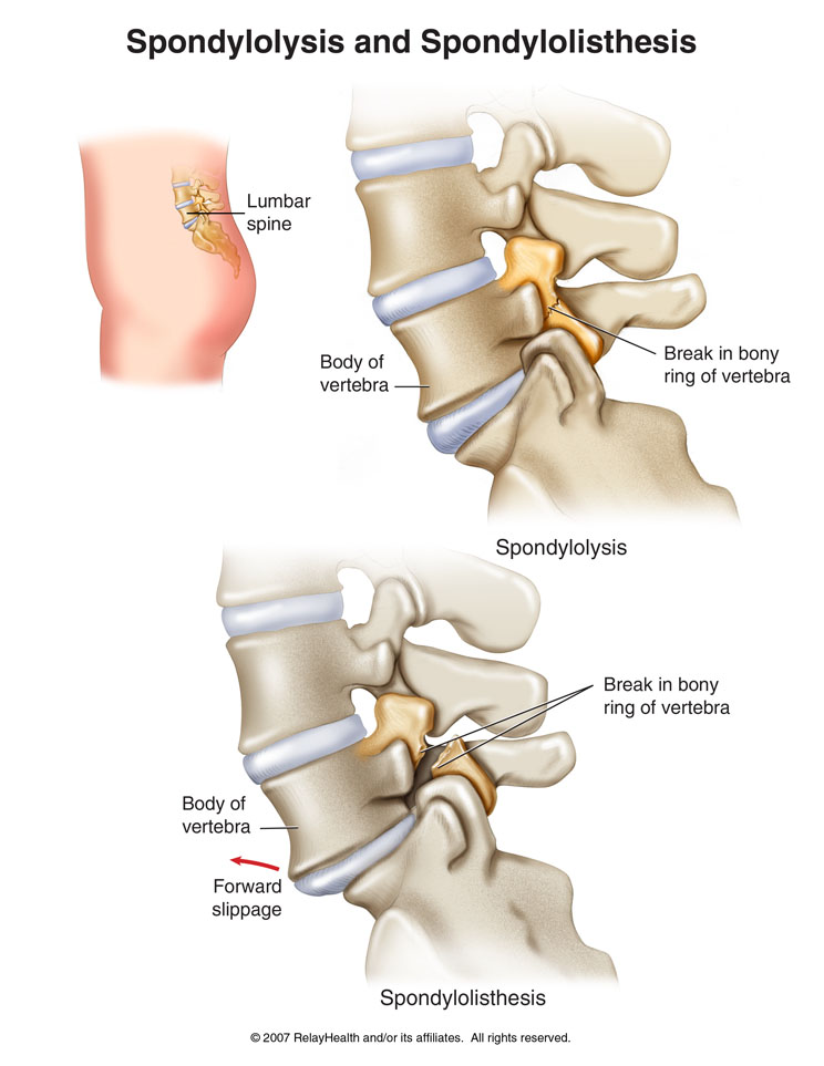 Spondylolysis and Spondylolisthesis Diagram
